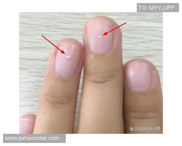 小孩指甲中间裂开的原因及护理方法详解